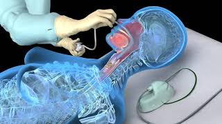 Nasotracheal suctioning NTS  3D animation [upl. by Nydnarb]