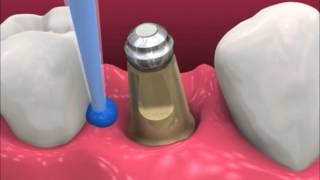 Smyl Manatee  Dental Implant Procedure [upl. by Rihat379]