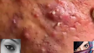 Severe Cystic Acne Infection Treatment Young Age [upl. by Okikuy]