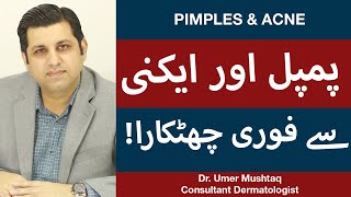 How To Remove Pimples Overnight  Acne Treatment  Pimple Khatam Karne Ka Tarika [upl. by Veljkov]