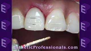 Class II Amalgam 19 MO Acadental  Amalgam Preparation Technique [upl. by Anjanette]