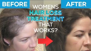 Hair Loss Treatment for Women with Advanced Trichology [upl. by Jadda]