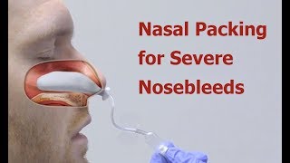 How To Stop A Nosebleed Dos and Donts [upl. by Nohsar]