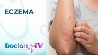 Eczema Symptoms Causes and Treatment  Doctors on TV [upl. by Noble]