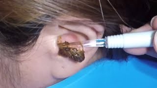 The Most Massive Earwax Removed in One Scoop [upl. by Akit]