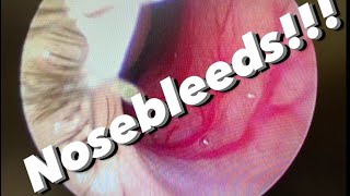 How to Stop a Nosebleed Fast Epistaxis Treatment [upl. by Flyn]