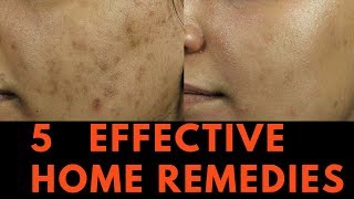 5 EFFECTIVE Home Remedies for Skin Pigmentation Brown Spots and freckles [upl. by Ennaillij665]