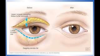 Diagnosis of Eyelid Spasm Disorders McClelland [upl. by Neetsyrk]