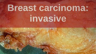 Invasive Breast Cancer We Teach You The Essentials [upl. by Nevyar751]