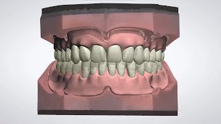 3Shape Dental System  Full Denture Design [upl. by Leanne998]