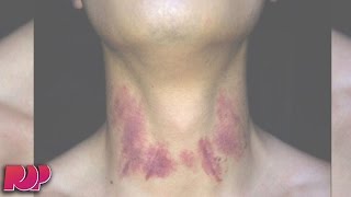 Teen Dies From His Girlfriends Hickey [upl. by Attlee]