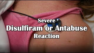 Disulfiram or Antabuse Reaction Emergency [upl. by Akinam281]