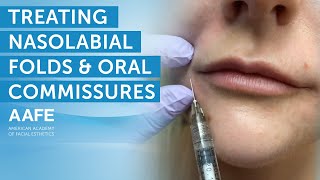 Using Dermal Fillers to Fill and Smooth Smile Lines  AAFE [upl. by Eulau345]