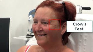 Crows Feet injections with botox in Bristol [upl. by Ezar970]