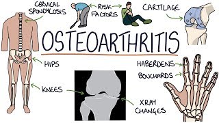 Understanding Osteoarthritis [upl. by Ellekram]