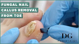 Fungal Nail Treatment And Callus Removal  The Foot Scraper DG Podiatrist [upl. by Leribag]