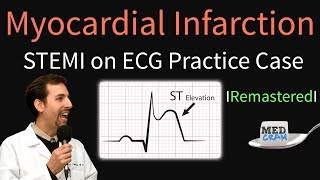 EKG changes seen with STEMIs [upl. by Caspar]