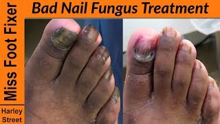 Bad toenail Fungus Treatment  How to cut fungal nails [upl. by Folger]