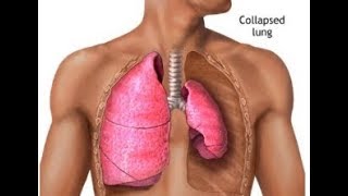 What is Lung Atelectasis Collapse [upl. by Ttenneb]