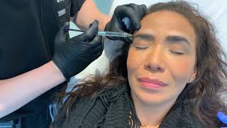 Brow Lift Using Fillers  Restalyne Defyne for Brows  West Hollywood CA  Dr Jason Emer [upl. by Nitreb]