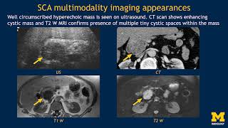 Imaging pancreatic cyst [upl. by Lekcar]