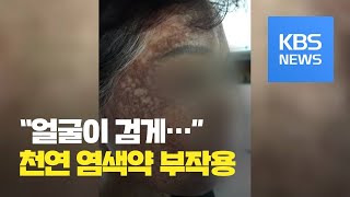 ‘천연 염색약’ 부작용…“가렵고 따갑고 얼굴 검게 변색”  KBS뉴스News [upl. by Adneram]