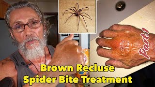 Brown Recluse Spider Bite Treatment Part 1  Dr Robert Cassar [upl. by Yun]