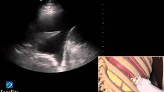 3D Lehrvideo Ultraschallgestütze Thoracentesis Untersuchung  SonoSite Ultraschall [upl. by Aynav]