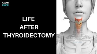 Life after Thyroidectomy [upl. by Halle]