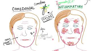 Acne Vulgaris causes subtypes and ttt [upl. by Dina]