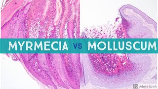 Molluscum vs Myrmecia Wart  Dermpath Lookalikes [upl. by Miarzim]