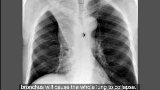 Respiratory System  Chest Conditions Atelectasis  Part 1 [upl. by Cati]