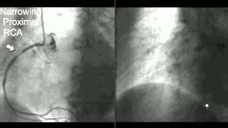 Coronary CT Angiography Cath [upl. by Girard]