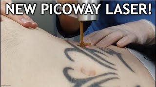 Laser Tattoo Removal  Sessions 46 Update [upl. by Willey]