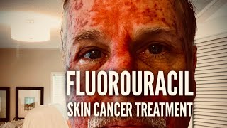 Fluorouracil Skin Treatment  Before During and After [upl. by Atinahc]