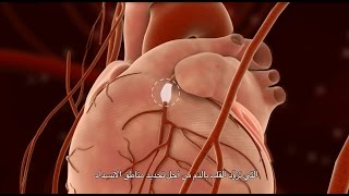 Percutaneous Coronary Intervention PCI [upl. by Xenia]