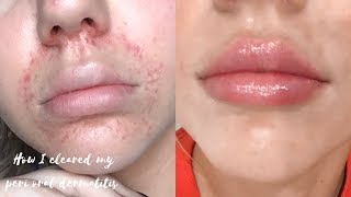 PERIORAL DERMATITIS  HOW I TREAT MY SKIN FLARE UPS [upl. by Elayne]