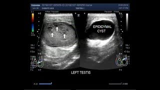 Ultrasound Video showing a mass in testis with torsion and an epididymal cyst [upl. by Ennyleuqcaj]