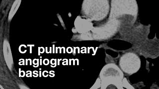 Pulmonary CT Angiogram Basics [upl. by Udell]