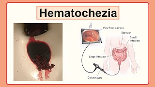 hematochezia [upl. by Redman]