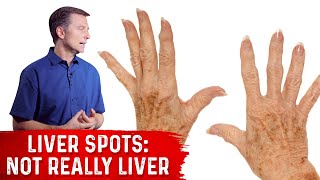 What Causes Liver Spots Age Spots – Dr Berg on Vitamin C Deficiency [upl. by Truman]