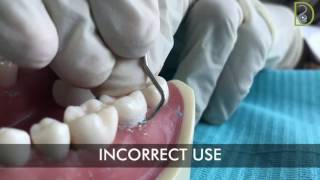 Dentiscope  How to use supragingival scalers [upl. by Megargee68]