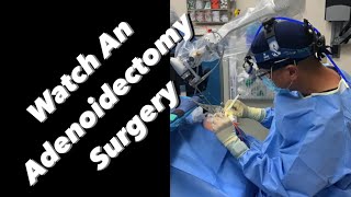 Adenoidectomy  actual footage [upl. by Vernor]