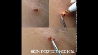 Virtually Painless Skin Tag Removal [upl. by Hoenack]