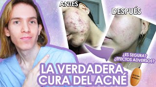 ROACCUTAN o ACCUTANE Efectos adversos como tomarla antes y despues LA VERDAD de la ISOTRETINOINA [upl. by Richlad]