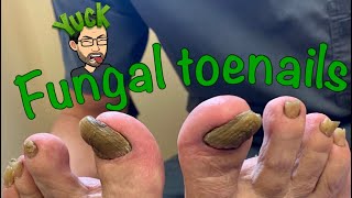 CUTTING LONG TOENAILS WITH FUNGUS [upl. by Egwan540]