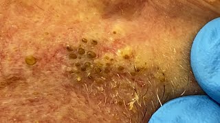 Extremely Clogged Pores Extracted  Contour Dermatology [upl. by Cheatham572]