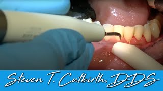 Scaling amp Root Planing  Dental Minute with Steven T Cutbirth DDS [upl. by Enilkcaj195]