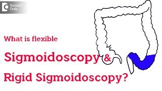 Rigid vs Flexible Sigmoidoscopy  Dr Rajasekhar M R [upl. by Kenison]