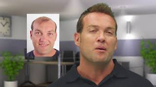 Jacques Kallis hair replacement procedure by Advanced Hair Studio [upl. by Ragan]